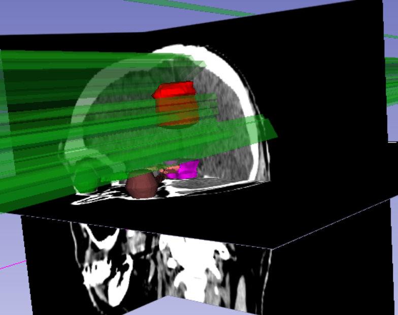 radiotherapy planning